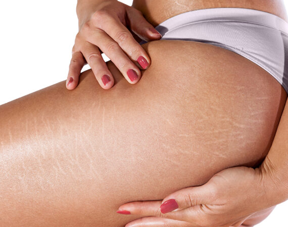 Stretch Marks | Remove Skin Imperfections Today | O'Laze