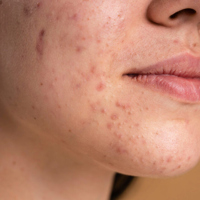 confident young woman with acne close up