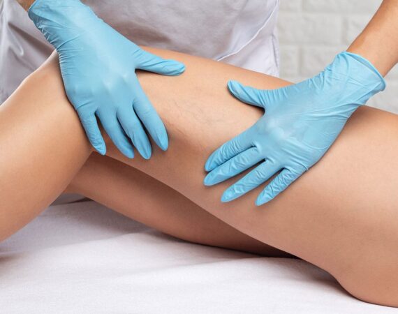 Spider Vein Treatment | The Best Care Is Self Care | O'Laze