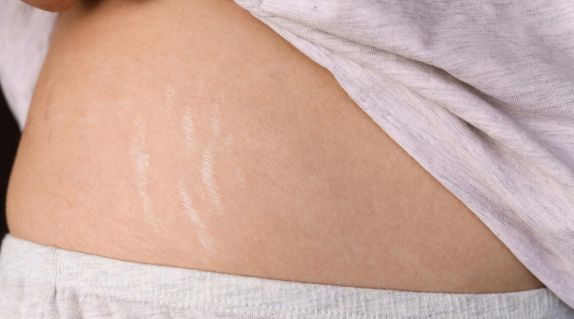 Stretch Mark Removal in Ascot Vale with O'Laze | O'Laze