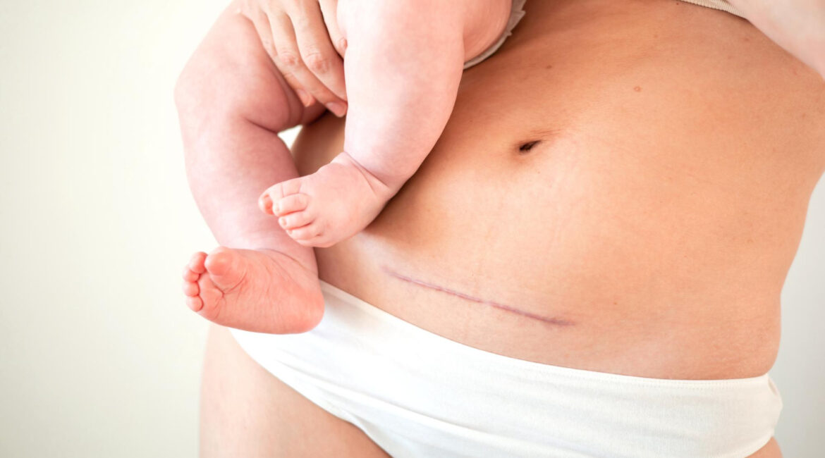 mom s abdomen after cesarean section scar seam young mother holds baby real motherhood