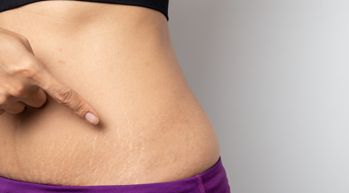 women show off belly after birth stretch marks white background